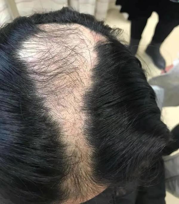 “10后”也禿了？小學(xué)女生不斷脫發(fā)，查出真相后，父母后悔不已